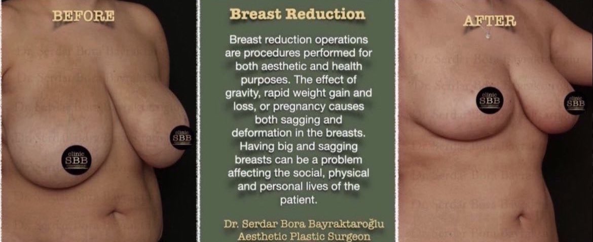 Clinicsbbintl's tweet photo. BREAST REDUCTION

You can get rid of the problems caused by sagging breasts with breast reduction

#clinicsbb #clinicsbbinternational #aestheticsurgery #plasticsurgery  #plasticsurgeon #serdarborabayraktaroglu #beforeafter #breastreduction #aesthetic https://t.co/AwZS8KbPQI