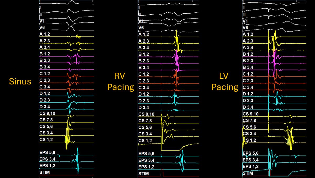 Timothy Maher, MD (@timothymahermd1) on Twitter photo In VT substrate mapping, wavefront direction is critical! Here is sinus, RV pacing, and LV pacing all at the same location on the inferior scar. The interaction of the wavefront direction with fixed lines of block create the split and late potentials. #ablateVT <a href="/BIDMC_VT/">BIDMC VT Center</a> In VT substrate mapping, wavefront direction is critical! Here is sinus, RV pacing, and LV pacing all at the same location on the inferior scar. The interaction of the wavefront direction with fixed lines of block create the split and late potentials. #ablateVT <a href="/BIDMC_VT/">BIDMC VT Center</a>