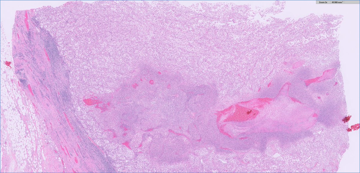 #GUpath nephrectomy:

clear cell RCC with rhabdoid differentiation (automatically grade 4; bad prognosis)➕tumor cell necrosis (itself also a poor prognostic finding in clear cell RCC)