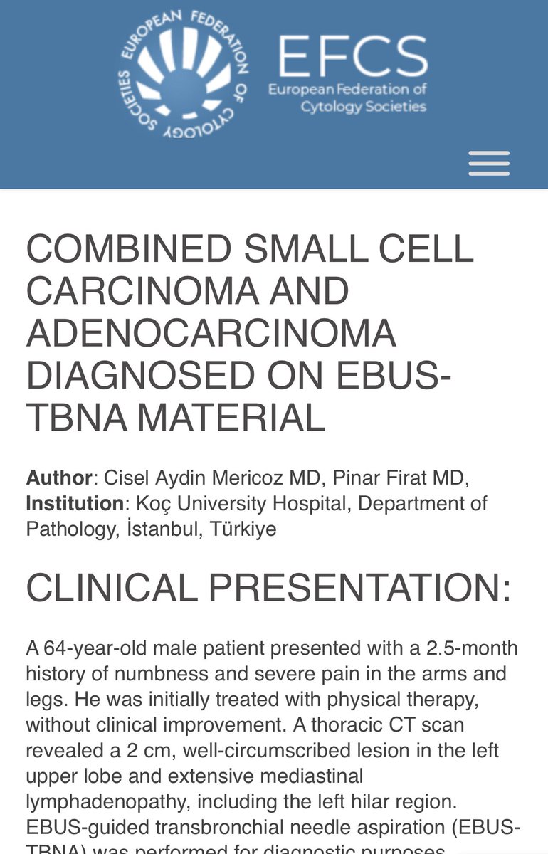Young EFCS (@efcsyoung) on Twitter photo EFCS’ Newsreel 📫 is back with the case of the month efcs.eu/case-of-the-mo… <a href="/ciselaydin/">Cisel Aydin Mericoz</a> #cytopath #ebusfna don’t miss it 🔬<a href="/turkishcytopath/">Turkish Cytopathology</a> <a href="/IACytology/">International Academy Cytology</a> <a href="/CytologyEFCS/">EFCS</a> EFCS’ Newsreel 📫 is back with the case of the month efcs.eu/case-of-the-mo… <a href="/ciselaydin/">Cisel Aydin Mericoz</a> #cytopath #ebusfna don’t miss it 🔬<a href="/turkishcytopath/">Turkish Cytopathology</a> <a href="/IACytology/">International Academy Cytology</a> <a href="/CytologyEFCS/">EFCS</a>