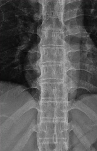 Keith Siau (@drkeithsiau) on Twitter photo Bamboo spine X-ray in a patient with back pain and diarrhoea. What’s the diagnosis? Bamboo spine X-ray in a patient with back pain and diarrhoea. What’s the diagnosis?
