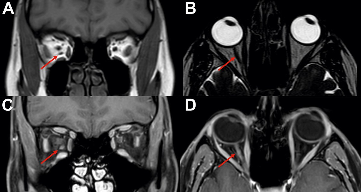 A 26-year-old woman with progressive binocular double vision was diagnosed with a right intraorbital tumor. Symptoms began 10 years ago with diplopia in extreme upgaze, worsening over time. Examination showed mild myopia, normal visual acuity, and an elevation deficit in