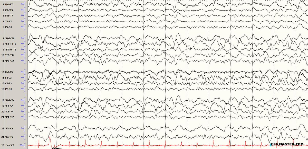 An adult patient with unknown history and altered mental status has following EEG findings. Assuming no work-up has been done, what is the next best step in management? Click on the link to submit answer and view explanation.  eegmaster.com/eegmaster/quiz…