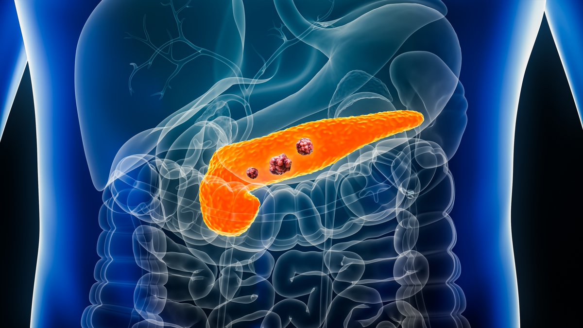 NCATS (@ncats_nih_gov) on Twitter photo Fighting #PancreaticCancer with a mix of drugs can help counter its genomic variation & drug resistance. A study by researchers at #NIH, <a href="/UNC/">UNC-Chapel Hill</a> & <a href="/MIT/">Massachusetts Institute of Technology (MIT)</a> used #MachineLearning models to identify & test 1.6 million drug pairs — resulting in >300 combinations showing promise in treating Fighting #PancreaticCancer with a mix of drugs can help counter its genomic variation & drug resistance. A study by researchers at #NIH, <a href="/UNC/">UNC-Chapel Hill</a> & <a href="/MIT/">Massachusetts Institute of Technology (MIT)</a> used #MachineLearning models to identify & test 1.6 million drug pairs — resulting in >300 combinations showing promise in treating