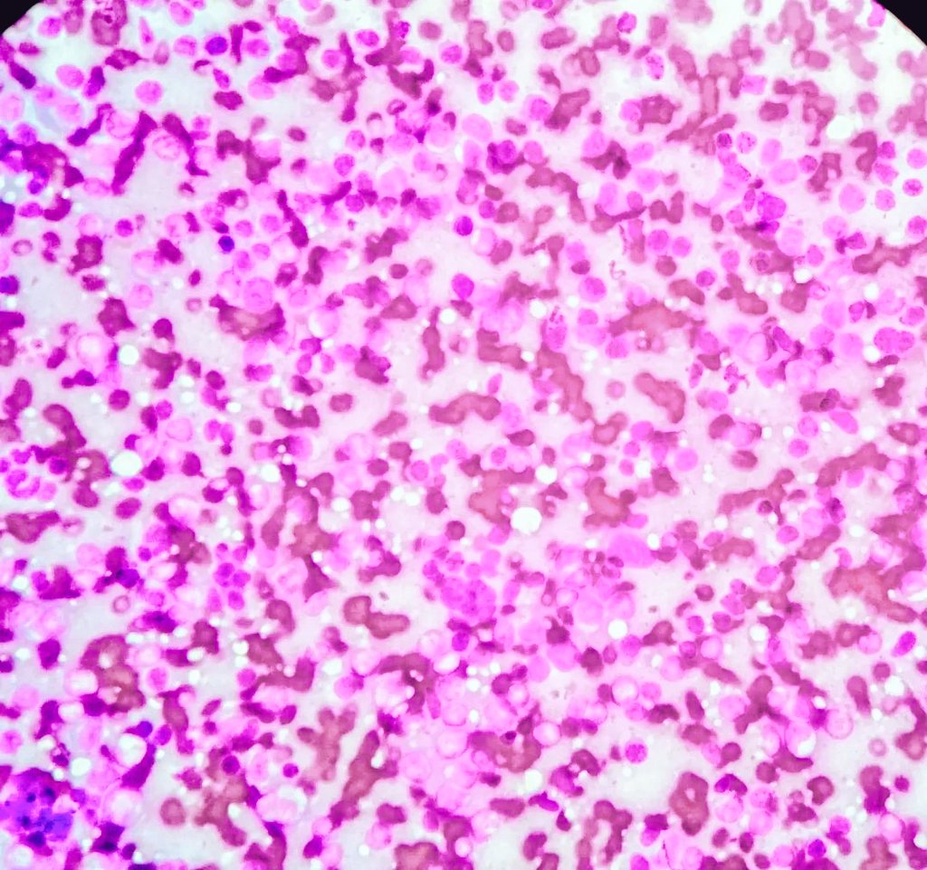 Roxana Chávez Cito. 🇲🇽 (@citopatoroxx) on Twitter photo Our first ROSE for this EBUS-FNA at <a href="/incanMX/">Instituto Nacional de Cancerología</a>. This wouldn't have been possible without the communication and teamwork with Dr. Menchaca (Pic 2) and all the willingness of residents and, of course, all the cytopath and surgical team. Pic 1: Dr. Yareli (R4) and Dr. Mónica Serrano. Our first ROSE for this EBUS-FNA at <a href="/incanMX/">Instituto Nacional de Cancerología</a>. This wouldn't have been possible without the communication and teamwork with Dr. Menchaca (Pic 2) and all the willingness of residents and, of course, all the cytopath and surgical team. Pic 1: Dr. Yareli (R4) and Dr. Mónica Serrano.