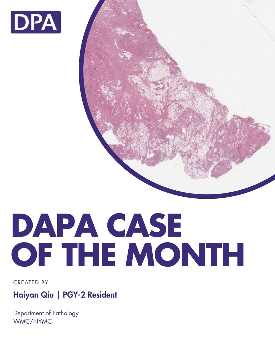 dpatweet's tweet image. A 45-year-old woman presents to the emergency department. Imaging reveals a 4 cm left renal mass. Subsequently, the patient undergoes nephrectomy. Gross examination reveals a well-circumscribed tumor.
Contributed by: Haiyan Q.
Take the assessment: zurl.co/hwhAn