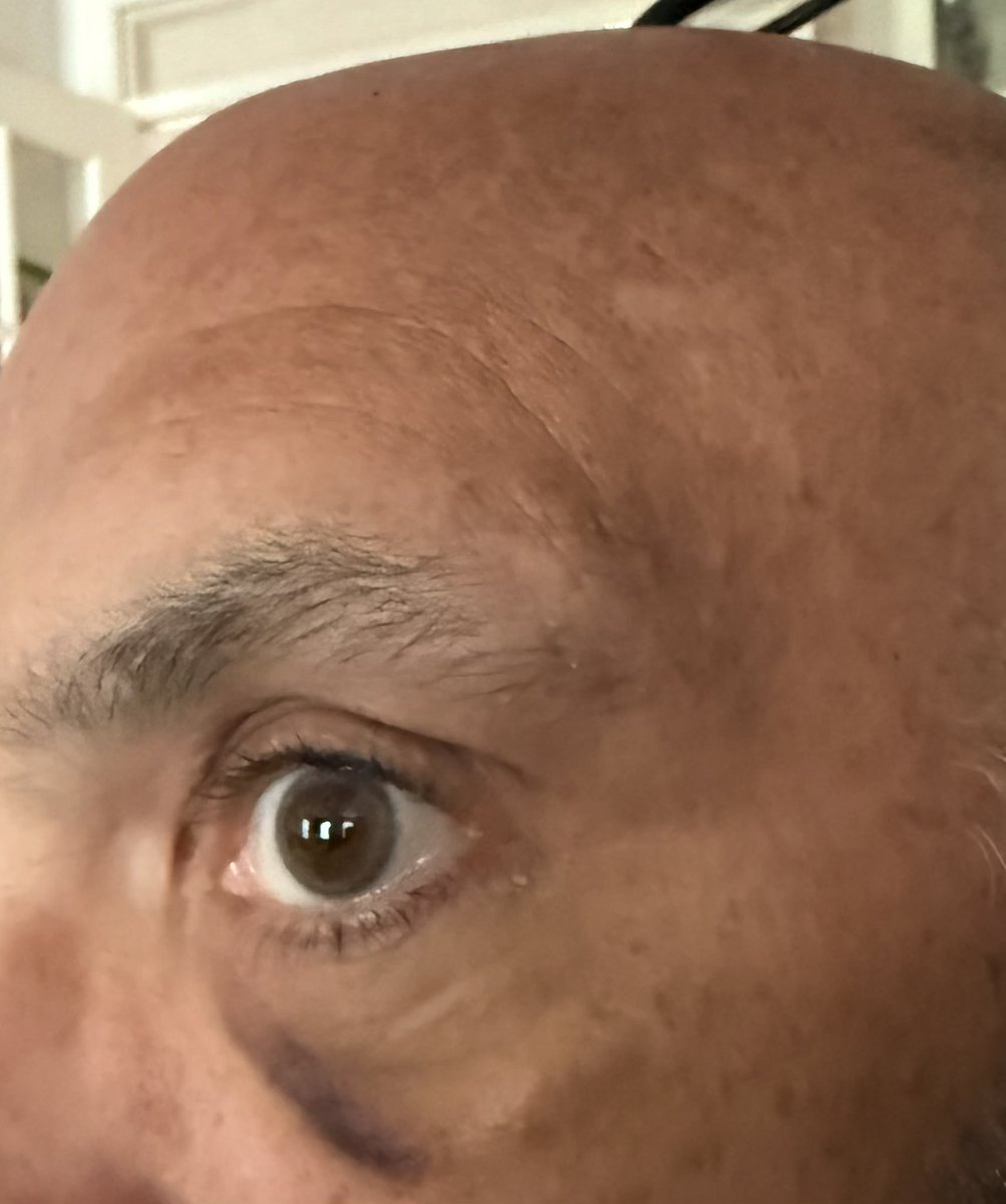 And sometimes you play with your German Shepherd and get headbutted right in the eye. Looks like I didn’t make <a href="/melaniemay79/">mel</a> her sammich fast enough.