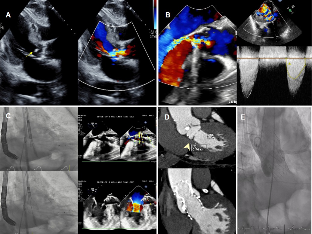 DeBakey CV Education - World Class CV Training (@debakeycvedu) on Twitter photo New #DeBakeyCVJournal Case! TAVI in Complex Dual-Level Obstruction: A Case of Severe Aortic Stenosis and Subaortic Membrane by Salem Assiri, Mohammed Alshammakh, Sultan Alzahrani, Moath Said Alfawara, Khaled Al-Shaibi
Videos at doi.org/10.14797/mdcvj…
<a href="/maquinonesmd/">M Quinones MD, MACC</a> <a href="/NadeenFaza/">Nadeen N. Faza, M.D.</a> New #DeBakeyCVJournal Case! TAVI in Complex Dual-Level Obstruction: A Case of Severe Aortic Stenosis and Subaortic Membrane by Salem Assiri, Mohammed Alshammakh, Sultan Alzahrani, Moath Said Alfawara, Khaled Al-Shaibi
Videos at doi.org/10.14797/mdcvj…
<a href="/maquinonesmd/">M Quinones MD, MACC</a> <a href="/NadeenFaza/">Nadeen N. Faza, M.D.</a>