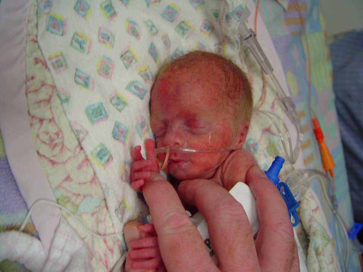 tabberg's tweet photo. Thanks to @VisionsInEd and the amazing teachers there, this girl has overcome all the odds - first to survive and then to thrive! From a 1.2-pound preemie to graduating with honors! #VisionsGrad #Classof2025 https://t.co/ZvjSZpFPAe