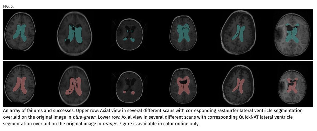 #OnlineFirst: Automated ventricular segmentation in pediatric hydrocephalus: how close are we?
thejns.org/pediatrics/vie…