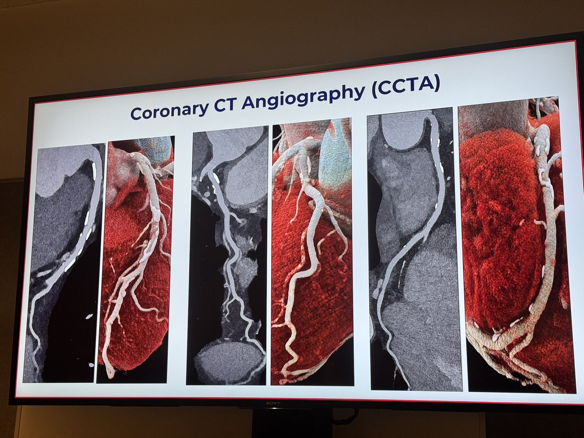 Dr. Martha Gulati ♥️🫀❤️🩹🇨🇦 (@drmarthagulati) on Twitter photo <a href="/RonBlankstein/">Ron Blankstein</a> visiting <a href="/SmidtHeart/">Smidt Heart Institute at Cedars-Sinai</a> and describing the potential role of #CCTA in primary prevention
🫀CAD is beyond stenosis-entire spectrum starting with plaque
🫀can help determine who needs ASA, refine lipid lowering tx
🫀quanitative plaque analysis is now possible
#YesSCCT <a href="/RonBlankstein/">Ron Blankstein</a> visiting <a href="/SmidtHeart/">Smidt Heart Institute at Cedars-Sinai</a> and describing the potential role of #CCTA in primary prevention
🫀CAD is beyond stenosis-entire spectrum starting with plaque
🫀can help determine who needs ASA, refine lipid lowering tx
🫀quanitative plaque analysis is now possible
#YesSCCT