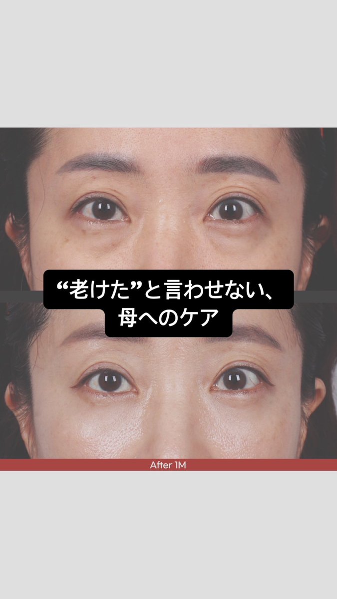 lemiel_jp's tweet photo. クマ・たるみで老けて見える目元、😥
ルミエルのアンコール目の下脂肪再配置で自然に若返り✨

当日施術できて、ダウンタイムが短いため
翌日も旅行を楽しめるのが魅力です🥰

✅1週間のLINE経過確認と、
その後も安心のアフターケアあり。

😄LINEでお気軽にご予約・ご相談ください。 https://t.co/FnWJIZtfdy