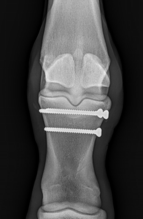 The attending veterinarian is an invaluable 1st line of defense at the race barn-responsible for daily care/ monitoring. This 2-yr-old STB filly was training well but "not quite right". Her vet investigated further and found a very short/early hairline fracture developing in a