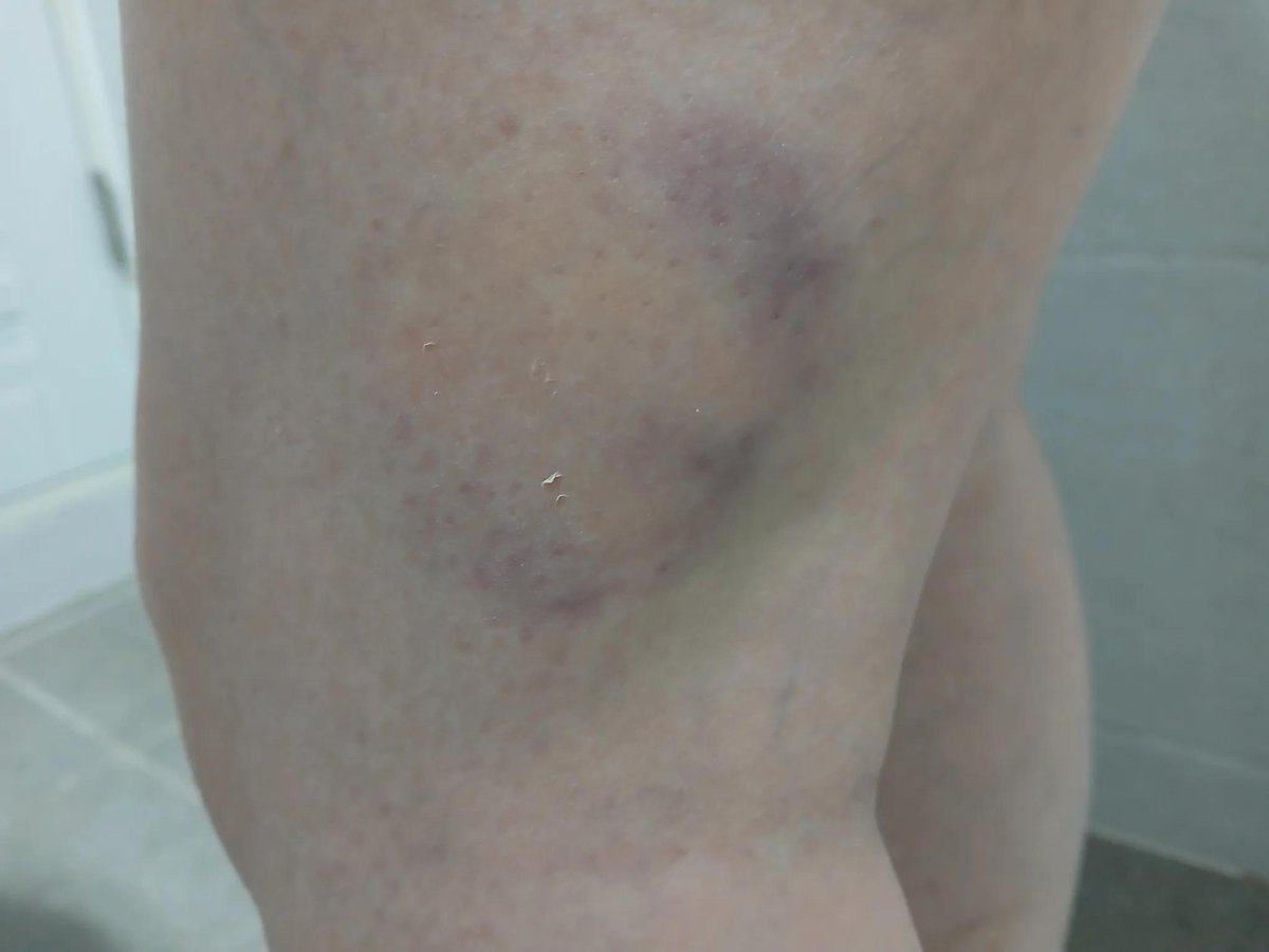 [전달요청] 

뒷쪽으로 팔 꺾고 세게 조인 수갑과 강제연행으로 인한 상처와 멍들이야,,,,지금은 집이고,,,,,,
.
많이 퍼날라줘,,,,,
공론화 시켜줘,,,,
너무 아파서 진단서 떼고 선관위랑 견찰들 고소고발 할거야,,,
.
기도부탁해,,,,
이 나라에 정의와 공의가 바로 세워지고 진짜 국민을 위하는