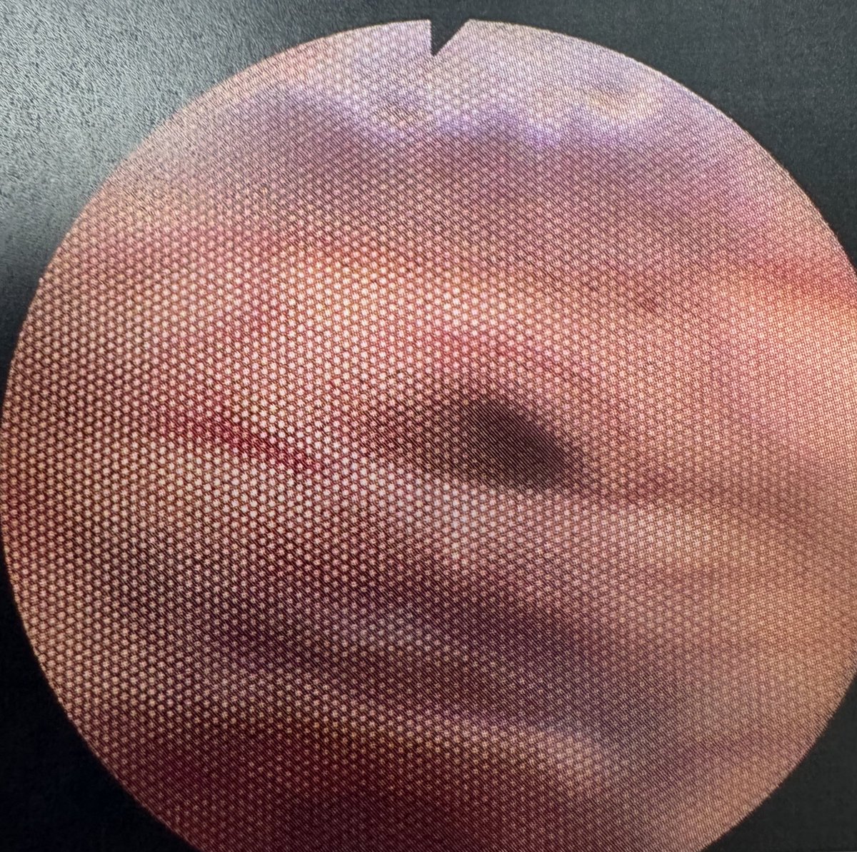 Jason Scott Hauptman MD PhD (@jshauptman) on Twitter photo Suprasellar cyst causing hydrocephalus - underwent endoscopic cyst fenestration, third ventriculostomy with 0 degree @karlstorzusa rigid little lotta. Then placed flexible endoscope to visualize aqueduct, which was patent. <a href="/PhxChildrens/">Phoenix Children's</a> <a href="/barrowpch/">Barrow Neurological Institute @ Phoenix Children's</a> <a href="/BarrowNeuro/">BarrowNeurological</a> Suprasellar cyst causing hydrocephalus - underwent endoscopic cyst fenestration, third ventriculostomy with 0 degree @karlstorzusa rigid little lotta. Then placed flexible endoscope to visualize aqueduct, which was patent. <a href="/PhxChildrens/">Phoenix Children's</a> <a href="/barrowpch/">Barrow Neurological Institute @ Phoenix Children's</a> <a href="/BarrowNeuro/">BarrowNeurological</a>
