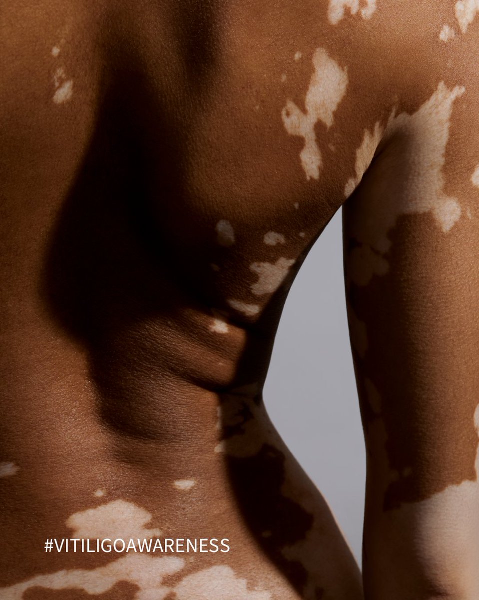 From herbal remedies to narrowband UVB therapy and topical JAK-inhibitors, vitiligo treatment has come a long way.

There is still much work to be done in order to create a safe, effective therapy that offers the potential for repigmentation and can be used long-term.

CLINUVEL
