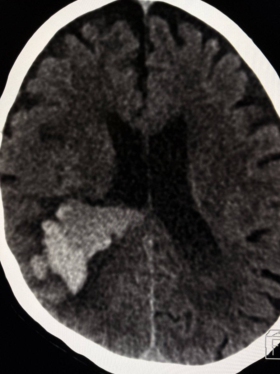 Layering or hematocrit level or differential density within an acute intraparenchymal bleed on CT?

Think: 1. coagulopathy  2. anticoagulants 3. Tumor-related bleed 4. evolving /expanding hematoma with active bleed.

—On-call pearls from my reporting list