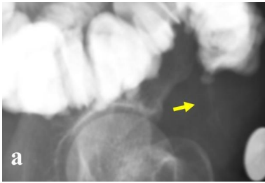 gastroudla's tweet photo. El enema opaco detecta complicaciones posquirúrgicas: 
-Fístula enterocutánea entre colon y piel: tras Valsalva, trayecto fistuloso delgado y lineal S: 60% E: 90% ¿Lo ves? 
-Fuga de la anastomosis: acumulación de contraste fuera de la luz intestinal S: 90% E: 100% #imagengastro https://t.co/A0WuxR9xUi