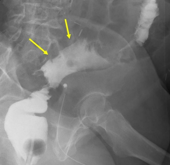 gastroudla's tweet photo. El enema opaco detecta complicaciones posquirúrgicas: 
-Fístula enterocutánea entre colon y piel: tras Valsalva, trayecto fistuloso delgado y lineal S: 60% E: 90% ¿Lo ves? 
-Fuga de la anastomosis: acumulación de contraste fuera de la luz intestinal S: 90% E: 100% #imagengastro https://t.co/A0WuxR9xUi