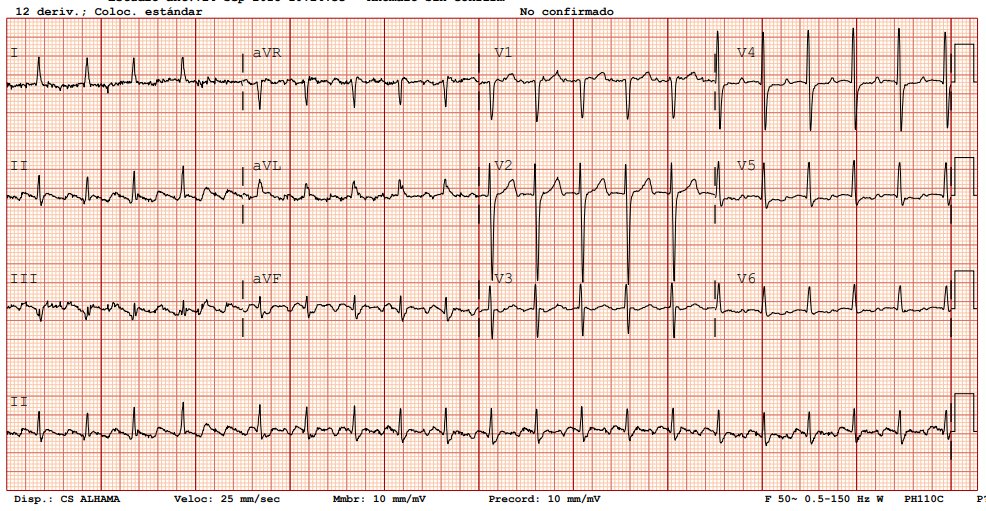 ♂️ 66 años con antecedentes de HTA, DLP y EPOC que acude por pulso irregular y disnea de dos días de evolución. Tensión arterial 140/90 mmHg.

¿Diagnóstico y plan?

Disfruta de los asaltos carprimur 👉carprimur.com/c/asalto-ecg/

#AsaltoECG