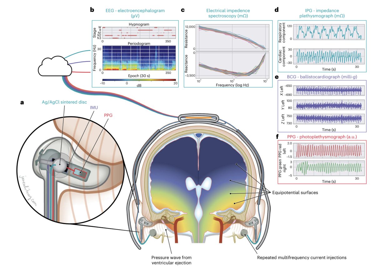 A wireless device for continuous measurement of brain parenchymal resistance tracks glymphatic function in humans

Glymphatic enhancement offers a novel disease prevention and treatment strategy

In <a href="/Nature/">nature</a> by AppliedCognition.com nature.com/articles/s4155…

From