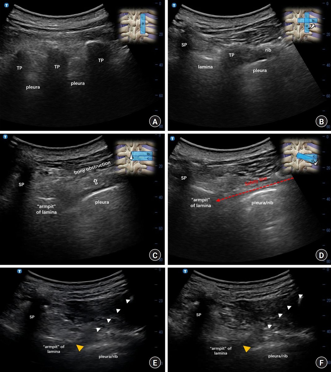 Korean Journal of Anesthesiology (KJA) (@korean_j_anesth) on Twitter photo We proposed a simple superoposterior approach for thoracic transforaminal epidural injection under ultrasound guidance. Used to control multi-nerve zoster pain, as epidural contrast spread covered all involved nerves in one shot.
doi.org/10.4097/kja.24… We proposed a simple superoposterior approach for thoracic transforaminal epidural injection under ultrasound guidance. Used to control multi-nerve zoster pain, as epidural contrast spread covered all involved nerves in one shot.
doi.org/10.4097/kja.24…