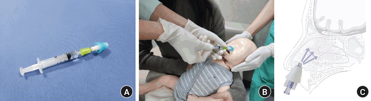 Korean Journal of Anesthesiology (KJA) (@korean_j_anesth) on Twitter photo The intranasal combination of dexmedetomidine (2 μg/kg) and ketamine (3 mg/kg) is a safe and effective alternative to chloral hydrate (50 mg/kg) for sedation in pediatric patients under 7 years, showing similar success rates but fewer complications.
doi.org/10.4097/kja.24… The intranasal combination of dexmedetomidine (2 μg/kg) and ketamine (3 mg/kg) is a safe and effective alternative to chloral hydrate (50 mg/kg) for sedation in pediatric patients under 7 years, showing similar success rates but fewer complications.
doi.org/10.4097/kja.24…