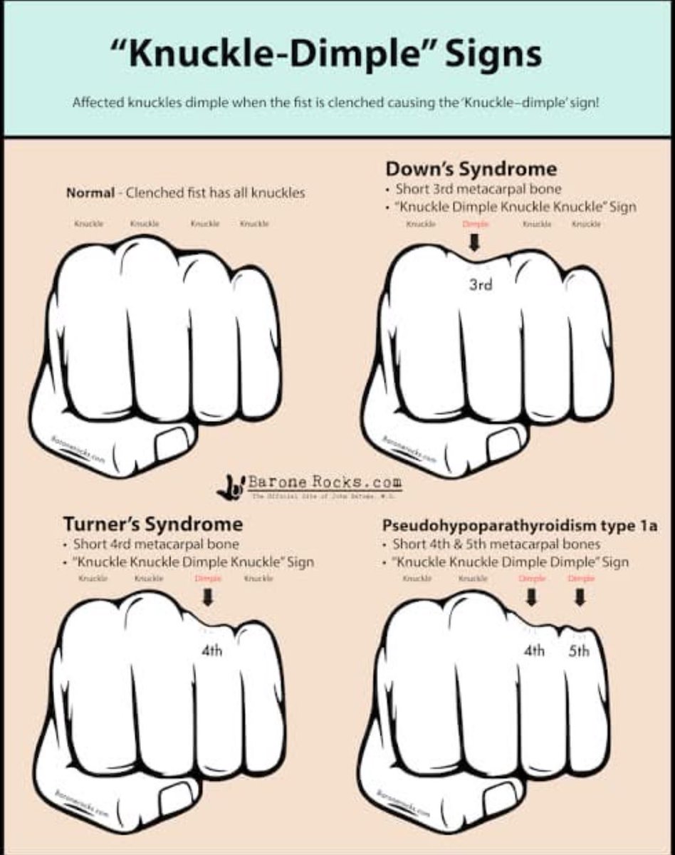 <a href="/IhabFathiSulima/">Dr Ihab Suliman</a> Turner's syndrome