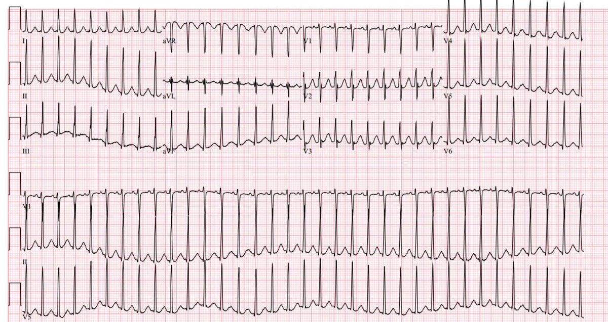 A 28-year-old otherwise healthy individual presents with sudden onset palpitations. What's your take?#ECG