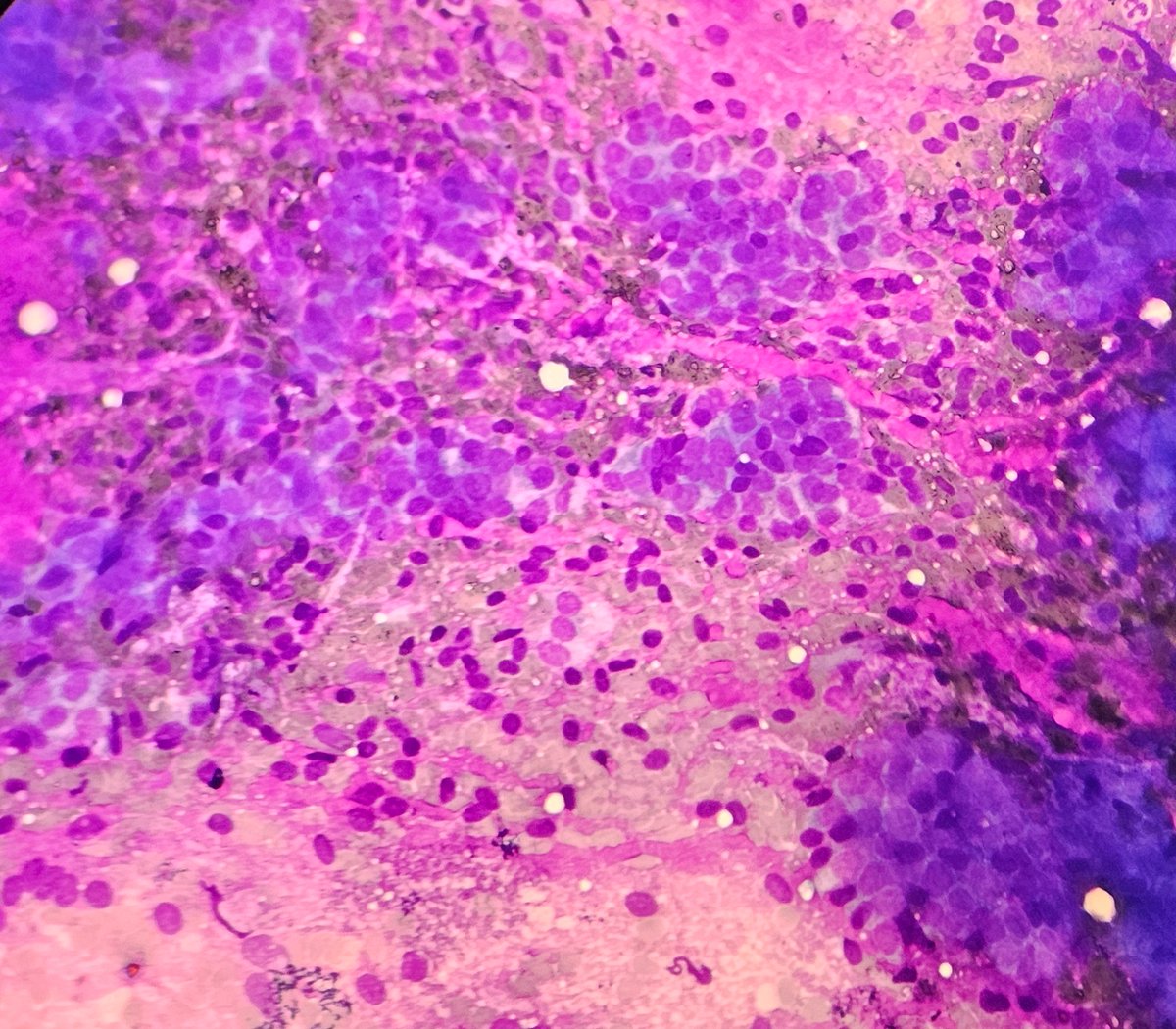 AnupamaArya12's tweet image. 25/F 2x2 cm Breast lump #cytopath #pathtwitter #breast @pepeheffernan @vi_monappa @kriyer68 @DrGeeONE @kr_abhisek