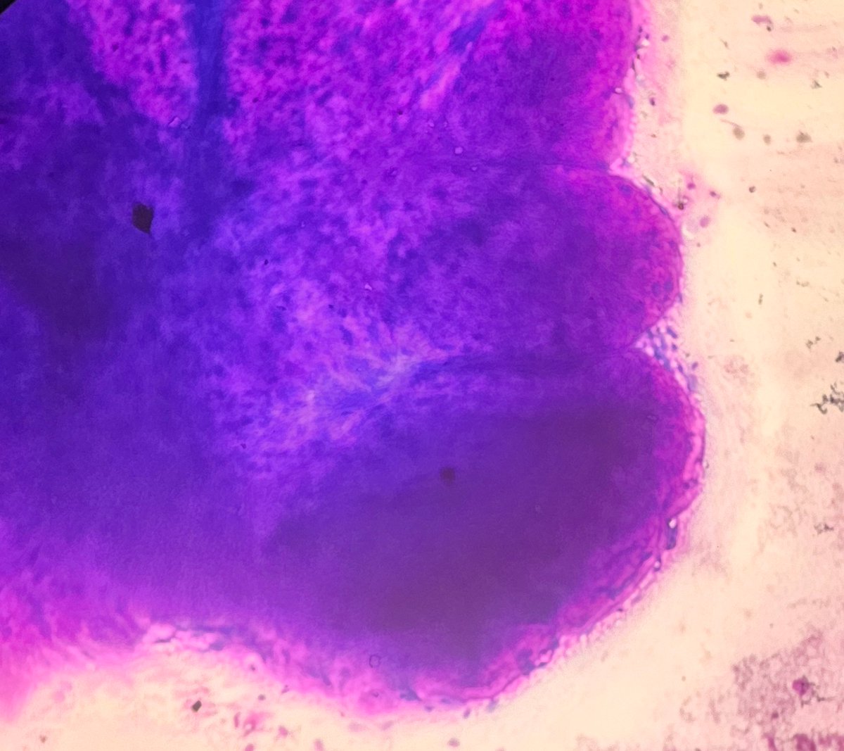 AnupamaArya12's tweet image. 25/F 2x2 cm Breast lump #cytopath #pathtwitter #breast @pepeheffernan @vi_monappa @kriyer68 @DrGeeONE @kr_abhisek