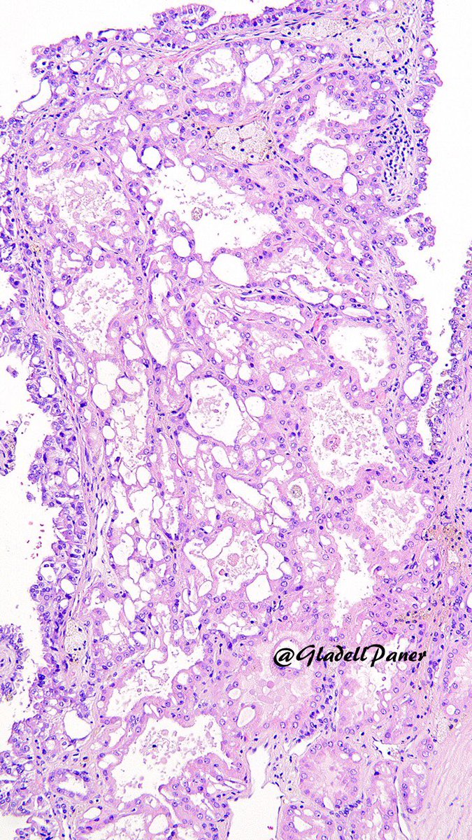 Clinical history often gives away the diagnosis of this uncommon #renal tumor. But let’s diagnose this through morphology side with its unique pattern as clue. 🔍 #OnePicDx 

What is your diagnosis on this #nephrectomy #GUPath tweeps? 

Answer in comment👇👇👇