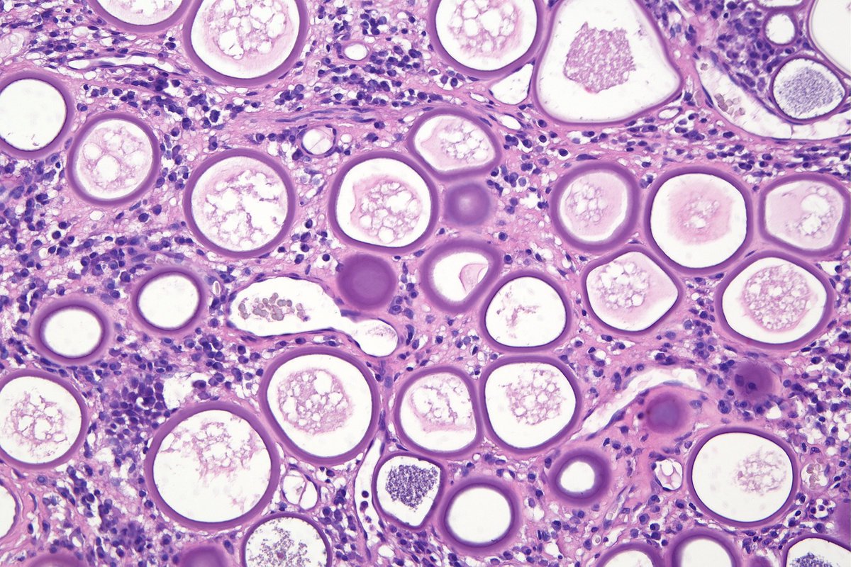 surgpathcases's tweet image. Conjunctiva

#pathology #patologia #idpath #eyepathology #ophthalmicpathology