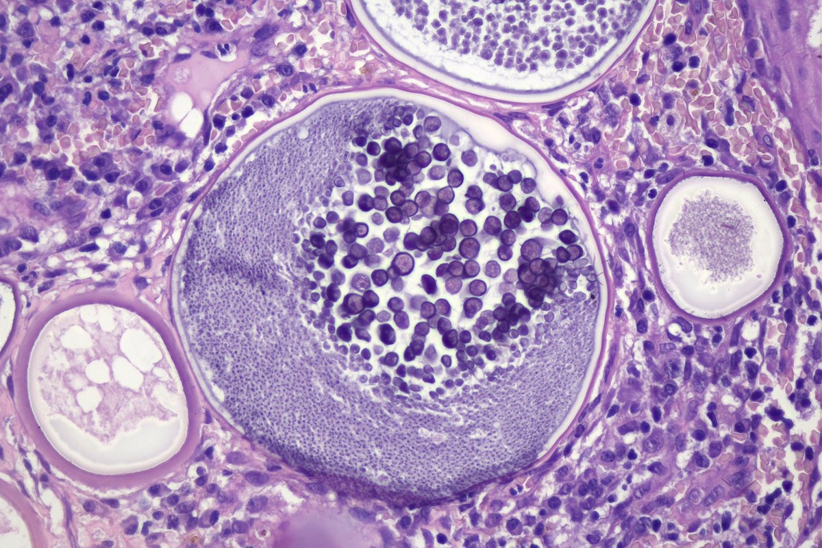 surgpathcases's tweet image. Conjunctiva

#pathology #patologia #idpath #eyepathology #ophthalmicpathology