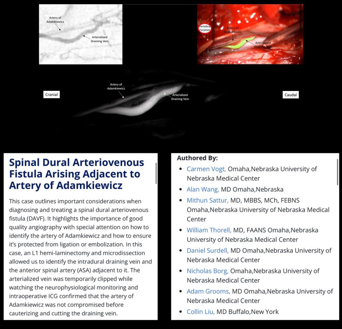 MGalganoMD's tweet image. Latest publication in CNS Nexus from the @unmc Neurosurgery group, detailing the management of a complex dAVF.
The tethered surgical video to this case is 🔥🔥🔥!
cns.org/nexus/case/det…
@CNS_Update
@BenElderMD