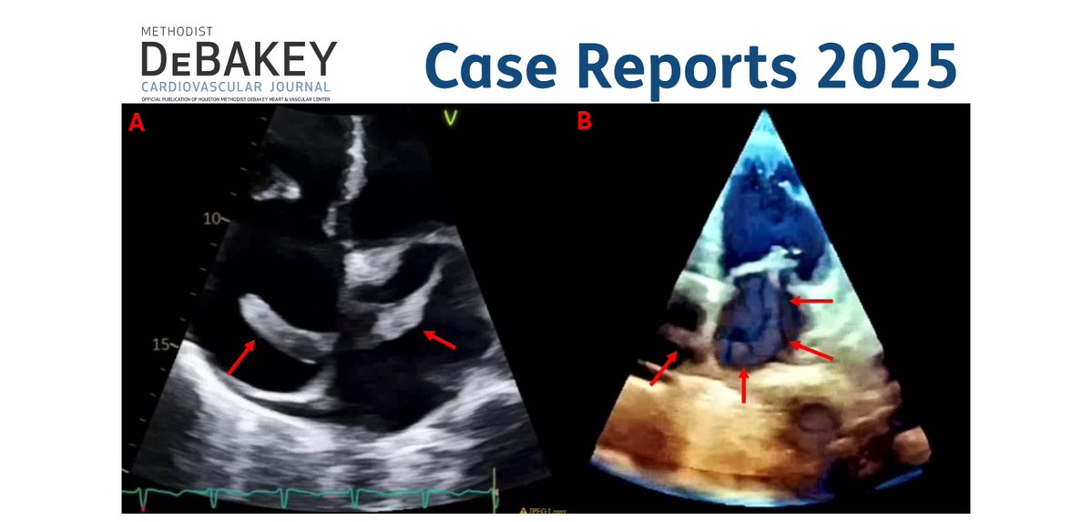 DeBakey CV Education - World Class CV Training (@debakeycvedu) on Twitter photo Share an interesting case! Submit "clinicalcases on novel scenarios related to CV. Submit ~1K words w/ images/videos at journal.houstonmethodist.org/about/submissi…
Or submit Multimodality Museum Images-see our Special Collections
journal.houstonmethodist.org/collections
#DeBakeyCVJournal <a href="/maquinonesmd/">M Quinones MD, MACC</a> <a href="/NadeenFaza/">Nadeen N. Faza, M.D.</a> Share an interesting case! Submit "clinicalcases on novel scenarios related to CV. Submit ~1K words w/ images/videos at journal.houstonmethodist.org/about/submissi…
Or submit Multimodality Museum Images-see our Special Collections
journal.houstonmethodist.org/collections
#DeBakeyCVJournal <a href="/maquinonesmd/">M Quinones MD, MACC</a> <a href="/NadeenFaza/">Nadeen N. Faza, M.D.</a>