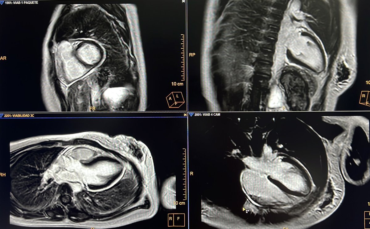 josecaferca's tweet image. Incessant pericarditis really exists #whyCMR