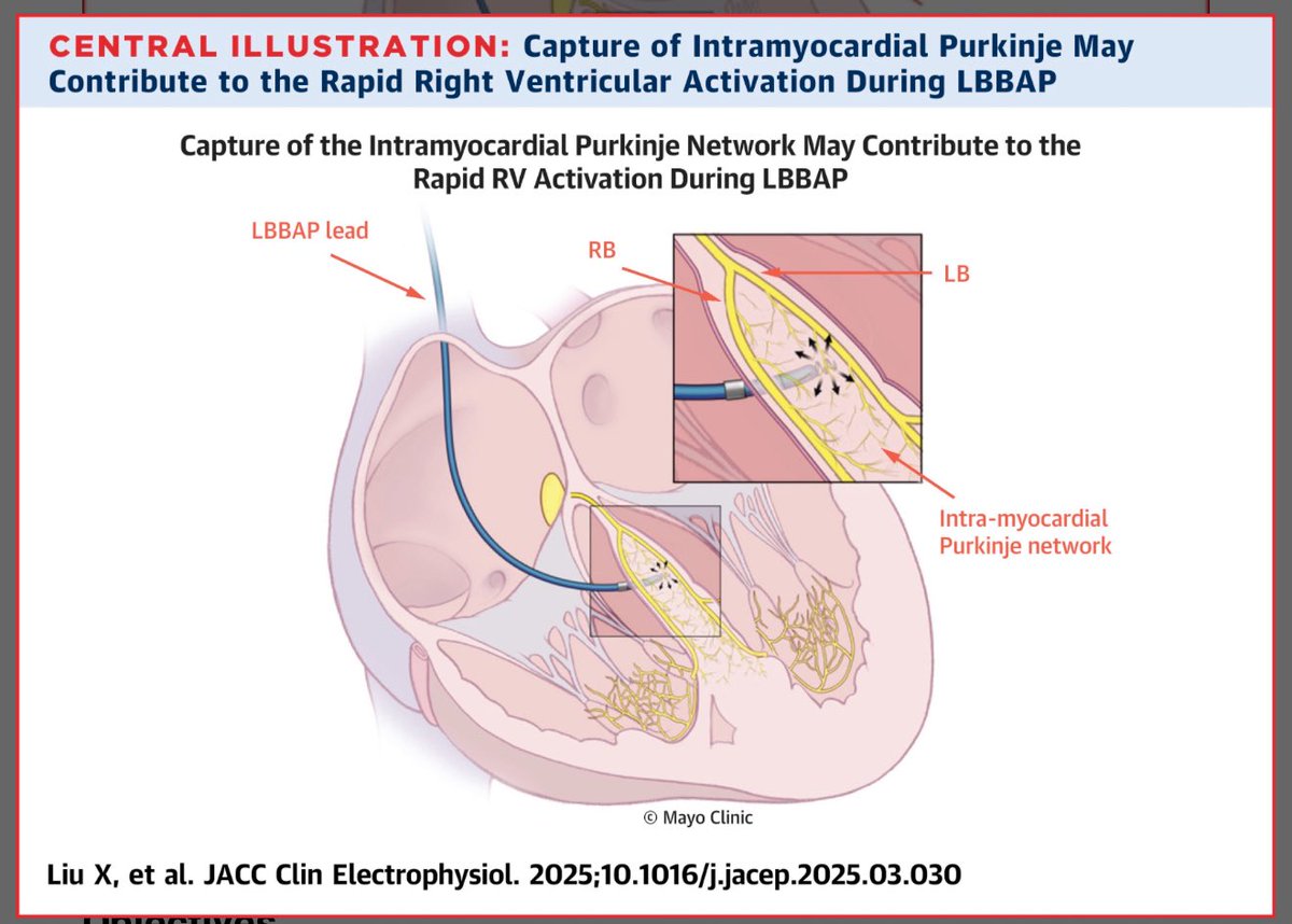 Septal Intramyocardial Purkinje Network: A Potential New Mechanism Explaining Left Bundle Branch Area Pacing Physiology | JACC: Clinical Electrophysiology jacc.org/doi/abs/10.101…