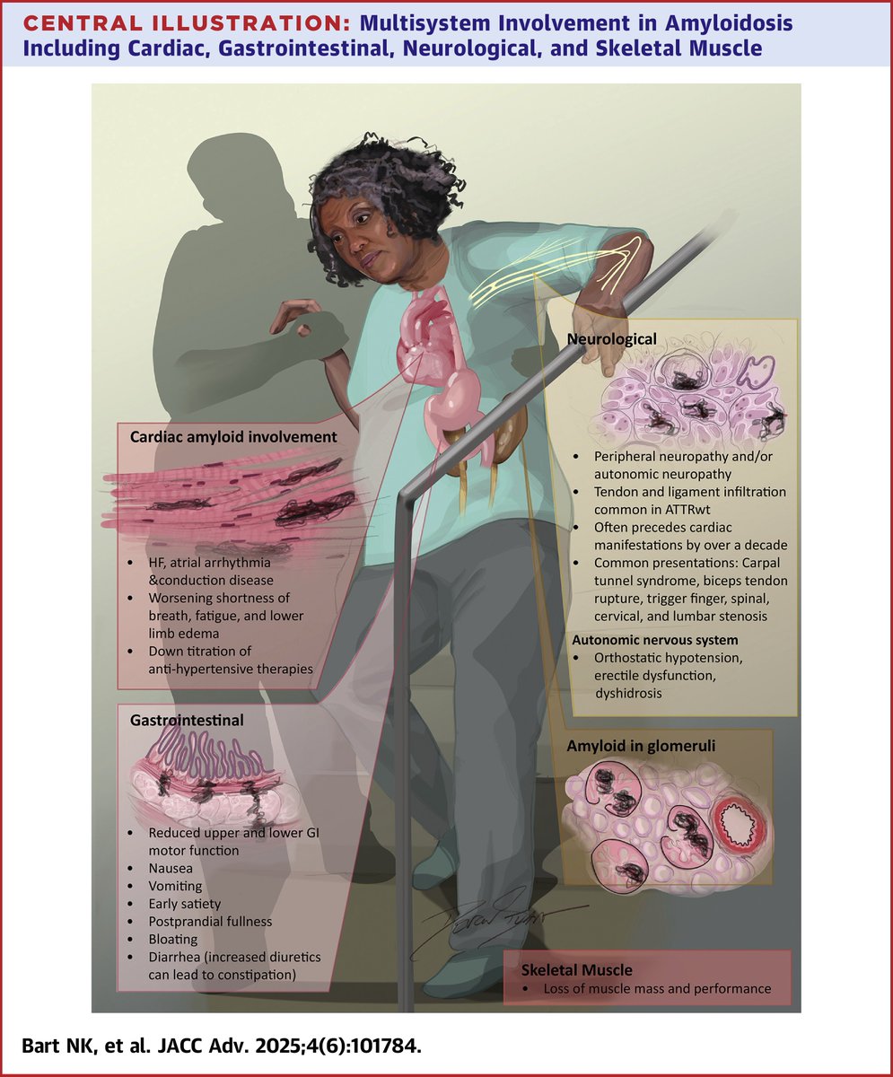 The intersectionality of cardiac amyloidosis, aging and frailty is the focus of a State-of-the-Art Review published in #JACCAdvances.

Read the journal scan to learn more: bit.ly/4dzdOvG #cvGeri