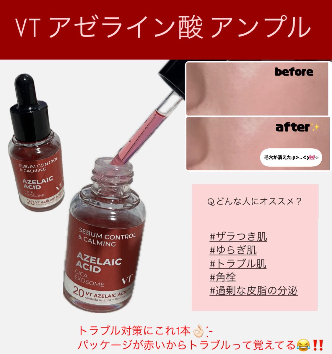 1024_hc's tweet photo. 【肌トラブルに悩む全ての人へ】

PRで貰ったけどリピ確商品発見💡⭐️
毛穴・角栓・ゆらぎにアプローチするVTのアゼライン酸✨️
テクスチャーも軽くてベタつかないから朝晩使いやすい◎透明感もなめらかさも、欲しかったのはこれでした🫧

#pr  #VTモニター #クレンジング #アゼライン酸 #ニキビケア https://t.co/tO7qlvyo3x
