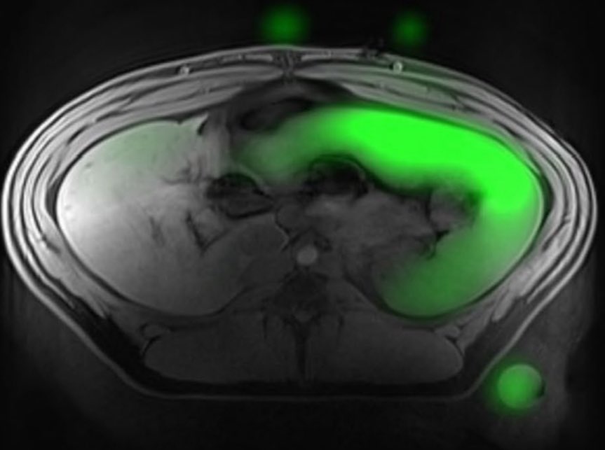 Alexander Maier (@alexm_official) on Twitter photo 📝 Important paper for us has gone public today: “Radial Hadamard-encoded 19F-MRI“ by Kian expands our interventional MRI 🧰 toolbox
<a href="/sfb1425/">SFB1425_MakeBetterScars</a> <a href="/UHZ_UNIFreiburg/">UHZ Freiburg - Bad Krozingen</a> <a href="/Uniklinik_Fr/">Uniklinik Freiburg</a>
Read 🧐 the full article here: doi.org/10.1007/s10334… 📝 Important paper for us has gone public today: “Radial Hadamard-encoded 19F-MRI“ by Kian expands our interventional MRI 🧰 toolbox
<a href="/sfb1425/">SFB1425_MakeBetterScars</a> <a href="/UHZ_UNIFreiburg/">UHZ Freiburg - Bad Krozingen</a> <a href="/Uniklinik_Fr/">Uniklinik Freiburg</a>
Read 🧐 the full article here: doi.org/10.1007/s10334…