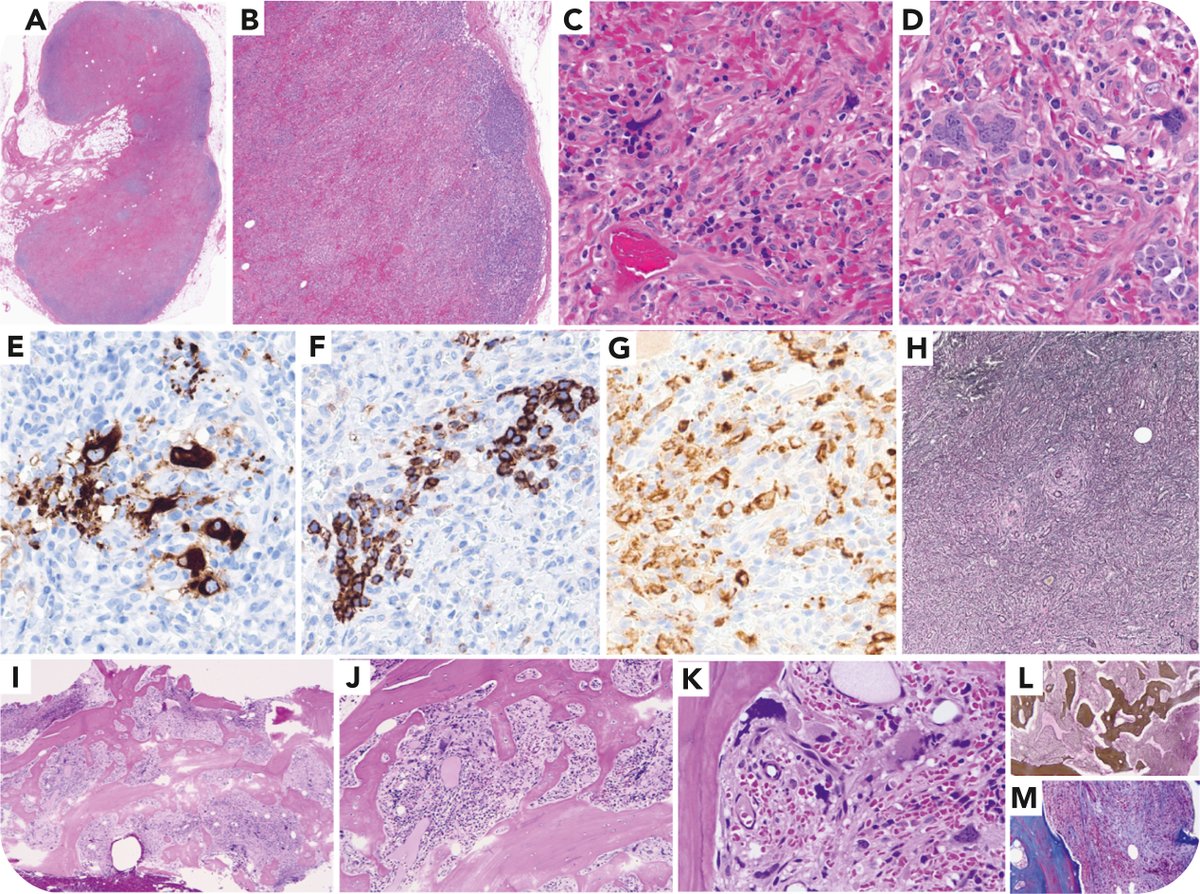 Primary myelofibrosis involving lymph nodes with the same mutational profile in bone marrow 
ow.ly/Tr1Z50W11ag #bloodwork #myeloidneoplasia