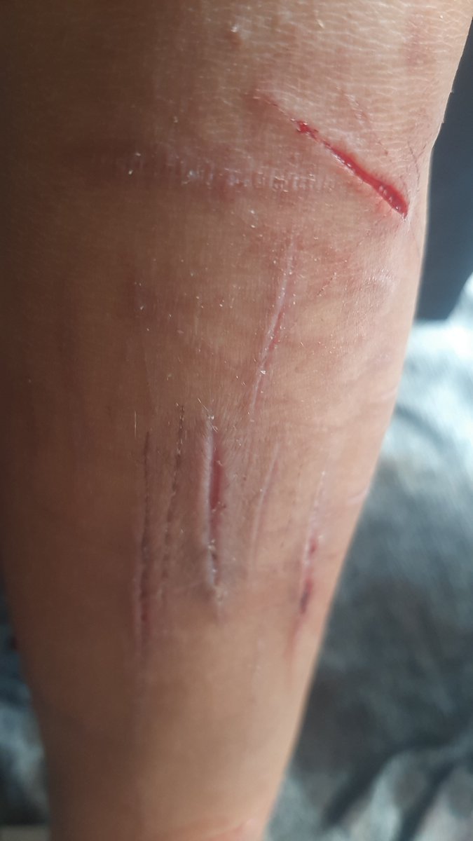 LexKilll's tweet photo. my scars

#shtwt https://t.co/I2gpGshCbL