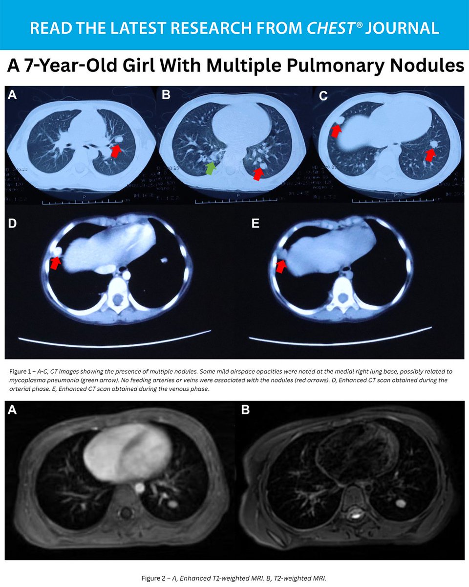 CHEST (@accpchest) on Twitter photo A 7-Year-Old Girl With Multiple #PulmonaryNodules 
What's the diagnosis? Read the full case presentation in the May issue to learn more: hubs.la/Q03p8GZ40
#MedEd #MedTwitter #PedsICU A 7-Year-Old Girl With Multiple #PulmonaryNodules 
What's the diagnosis? Read the full case presentation in the May issue to learn more: hubs.la/Q03p8GZ40
#MedEd #MedTwitter #PedsICU