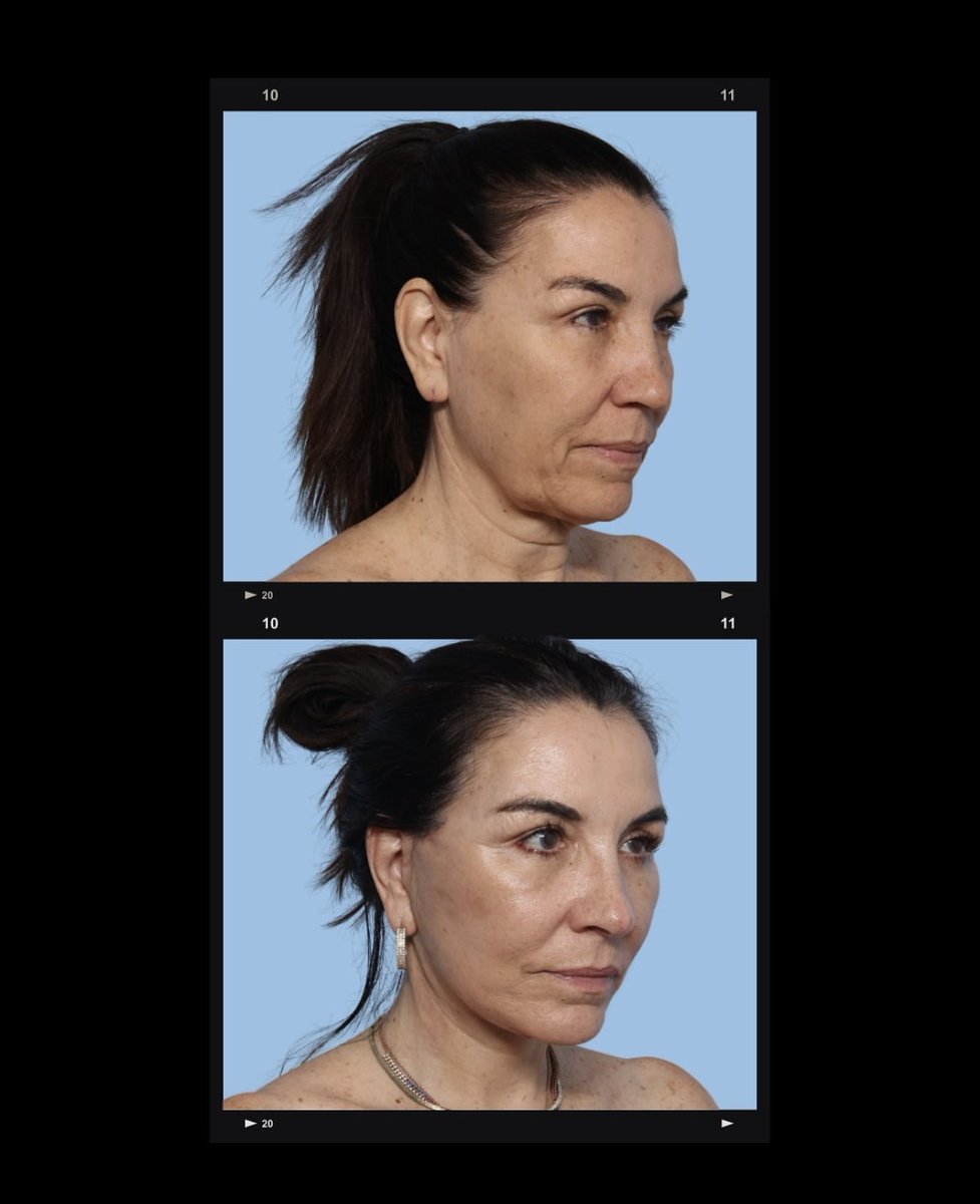 DRianMD's tweet photo. Say hello to M, Feeling on top of the world one month post-facelift! ✨ Embracing this fresh, vibrant glow and loving the confidence boost! 💖 #GlowUp 

No pain. No visible scarring. Just a radiantly lifted look. #faceliftmiami #beforeandafter #maercksmethod https://t.co/iL3XUcQAOg