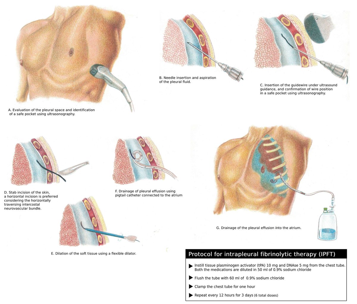 Humbly sharing our work 👇

Intrapleural tissue plasminogen activator and deoxyribonuclease in complex pleural effusion and empyema, clinical outcomes, and predictors - Yub Raj Sedhai, Rodney T. Steff, Karan Singh et al.  journals.sagepub.com/doi/10.1177/17…