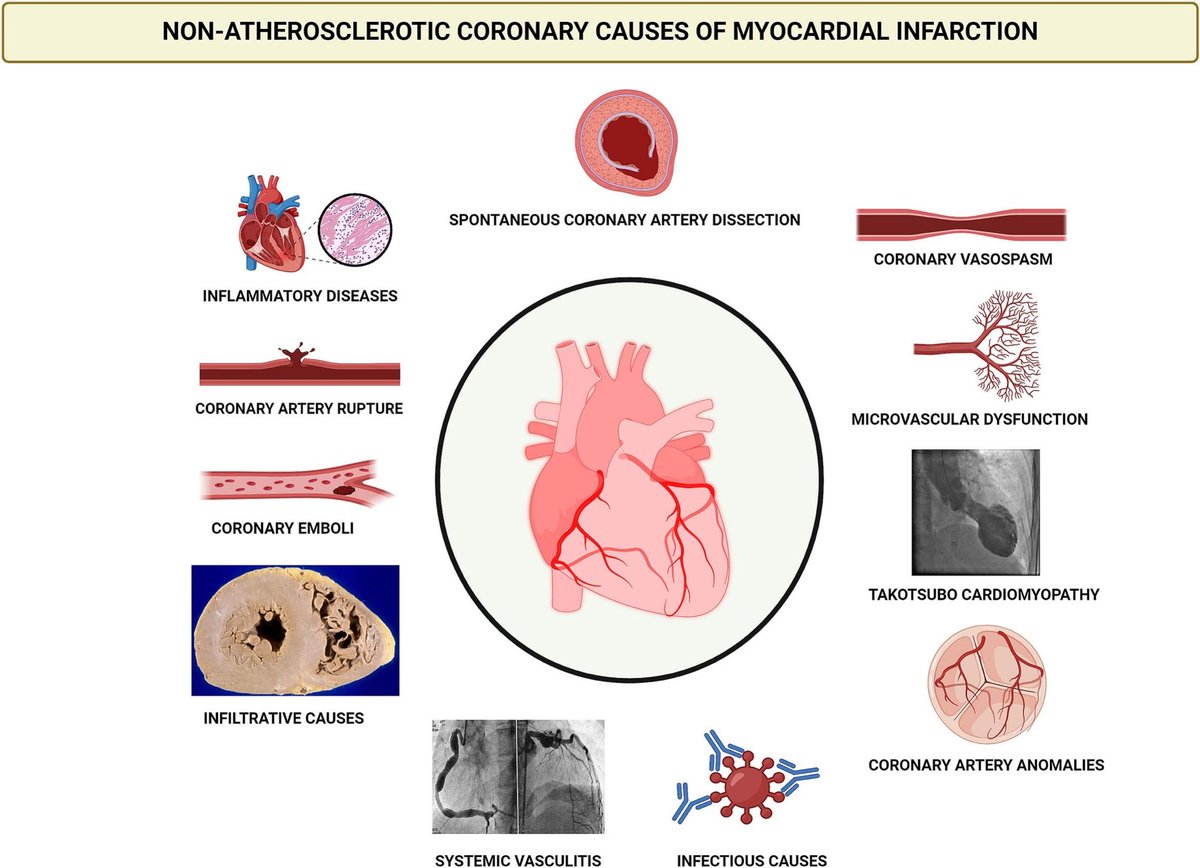 Progress in Cardiovascular Diseases (@pcvdjournal) on Twitter photo 📚 Non-atherosclerotic coronary causes of myocardial infarction in women
🔗 sciencedirect.com/science/articl…
<a href="/IAmDoctorAbhi/">Abhishek Chaturvedi MD</a> <a href="/hect2701/">Prof. Hector M. Garcia-Garcia</a> <a href="/ronwaksman/">ron waksman</a> <a href="/KritiKalra092/">Kriti Kalra, MD, FACC</a>
<a href="/ELS_Cardiology/">Elsevier Cardiology</a> <a href="/ElsevierConnect/">Elsevier</a>
#cardiotwitter #Cardio #CardioX #cardiovascular #CardioEd 📚 Non-atherosclerotic coronary causes of myocardial infarction in women
🔗 sciencedirect.com/science/articl…
<a href="/IAmDoctorAbhi/">Abhishek Chaturvedi MD</a> <a href="/hect2701/">Prof. Hector M. Garcia-Garcia</a> <a href="/ronwaksman/">ron waksman</a> <a href="/KritiKalra092/">Kriti Kalra, MD, FACC</a>
<a href="/ELS_Cardiology/">Elsevier Cardiology</a> <a href="/ElsevierConnect/">Elsevier</a>
#cardiotwitter #Cardio #CardioX #cardiovascular #CardioEd