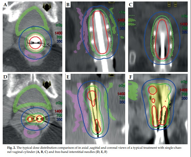 The aim of this study was to compare the dosimetric differences in vaginal brachytherapy (VBT) using single-channel vaginal cylinder (SCVC) and free-hand interstitial needles (FIN).
termedia.pl/Dosimetric-com…