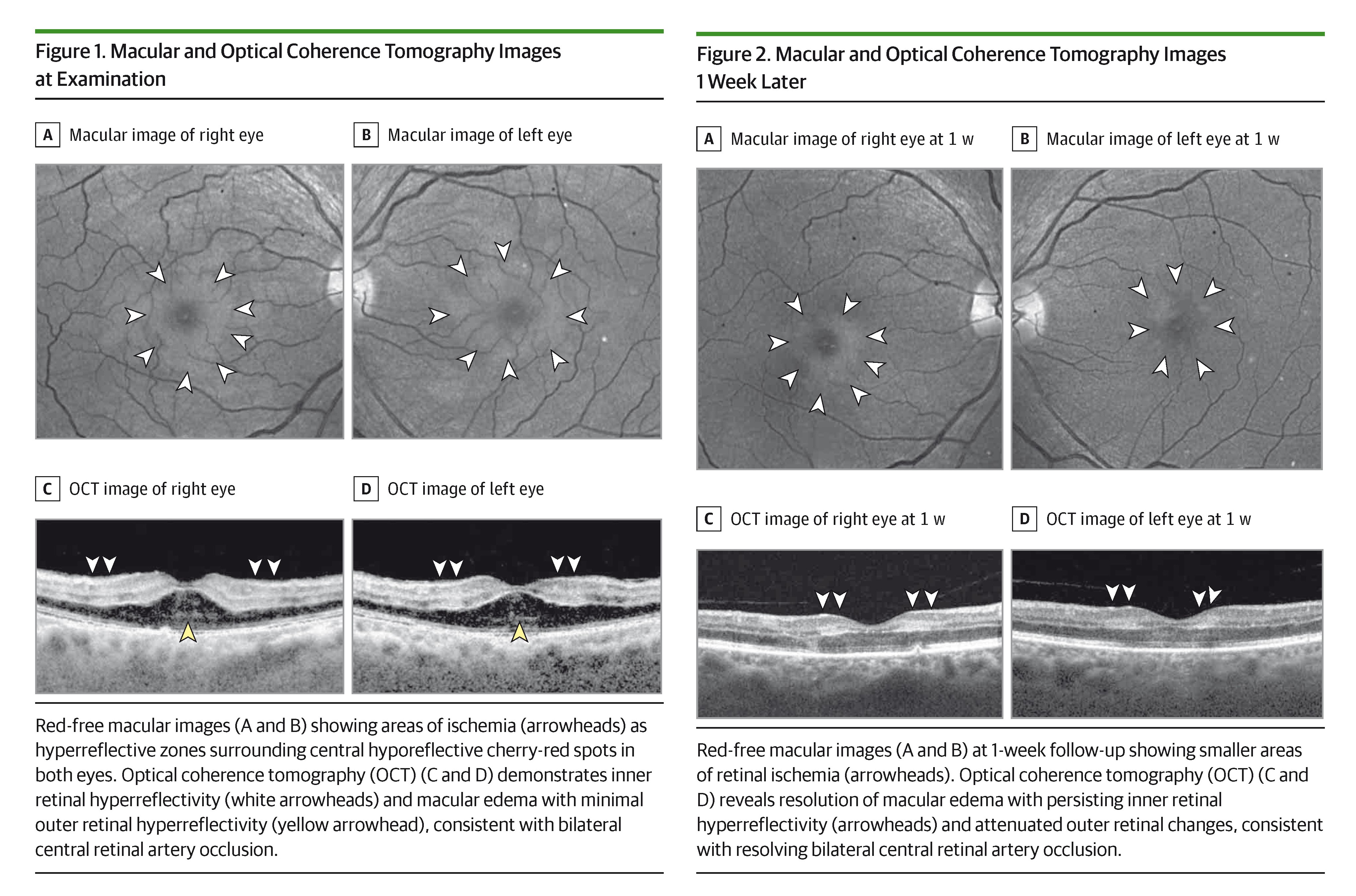JAMA Ophthalmology (@JAMAOphth) / X