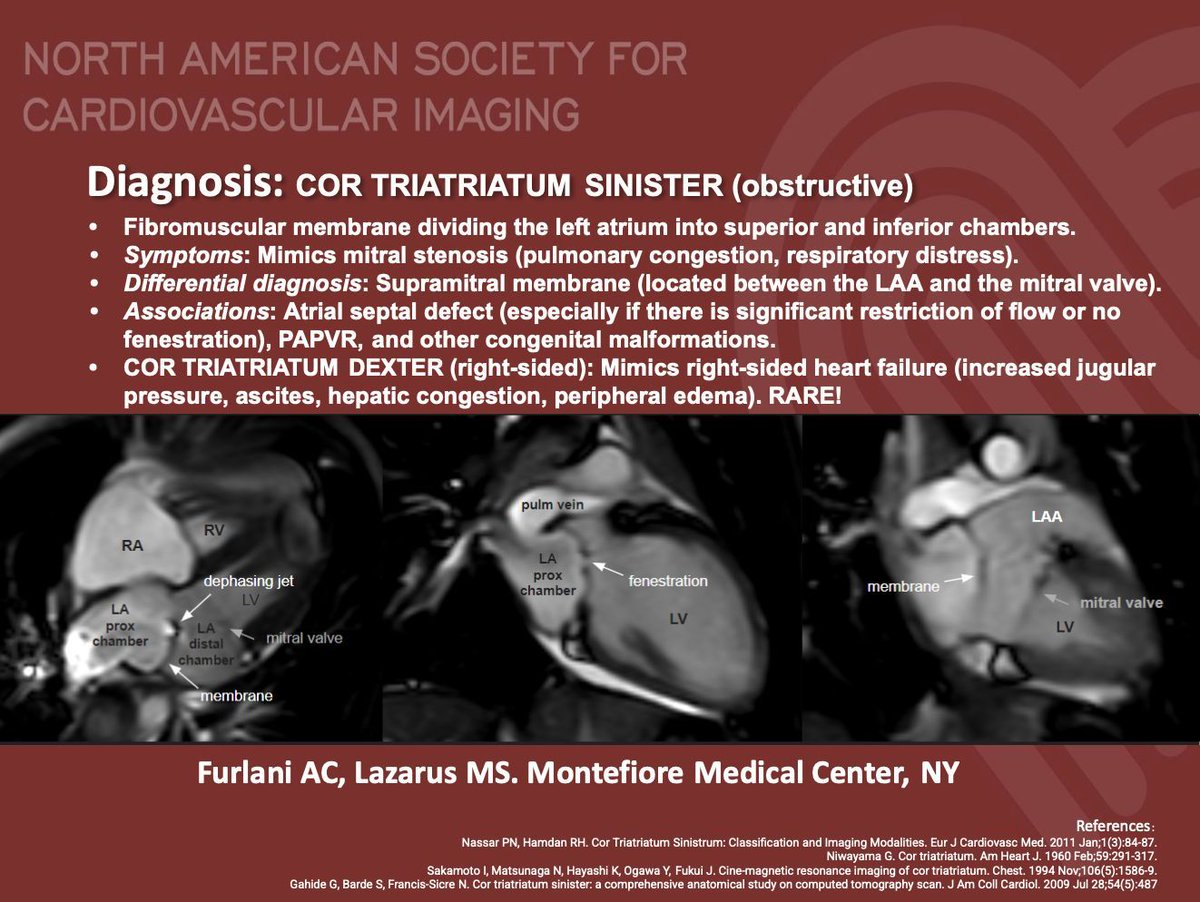 NASCI (@nascisociety) on Twitter photo #NASCI Case Series
Case 79 Diagnosis
Courtesy of @AndreaFurlaniMD from Montefiore Medical Center, NY
#whyCMR #YesCCT
<a href="/GregKicska/">Gregory Kicska</a> <a href="/JRevRad1/">Jonathan Revels DO, FSAR</a> <a href="/dianalitmano/">diana litmanovich</a> <a href="/DanielVargasMD/">Daniel Vargas, MD</a> <a href="/kirschj/">Jacobo Kirsch, MD, MBA, FACR</a> <a href="/prachipagarwal/">Prachi Agarwal</a> <a href="/AwsHamid5/">Aws Hamid, MD, MS</a> <a href="/EscrOffice/">ESCR Vienna</a> <a href="/CarlottaOnnis/">Carlotta Onnis</a> <a href="/DeCeccoCN/">Carlo N. De Cecco, MD, PhD</a> #NASCI Case Series
Case 79 Diagnosis
Courtesy of @AndreaFurlaniMD from Montefiore Medical Center, NY
#whyCMR #YesCCT
<a href="/GregKicska/">Gregory Kicska</a> <a href="/JRevRad1/">Jonathan Revels DO, FSAR</a> <a href="/dianalitmano/">diana litmanovich</a> <a href="/DanielVargasMD/">Daniel Vargas, MD</a> <a href="/kirschj/">Jacobo Kirsch, MD, MBA, FACR</a> <a href="/prachipagarwal/">Prachi Agarwal</a> <a href="/AwsHamid5/">Aws Hamid, MD, MS</a> <a href="/EscrOffice/">ESCR Vienna</a> <a href="/CarlottaOnnis/">Carlotta Onnis</a> <a href="/DeCeccoCN/">Carlo N. De Cecco, MD, PhD</a>
